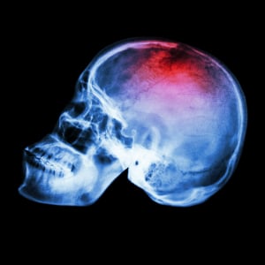 uraz czaskowo-mózgowy